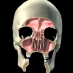 Patologie del seno mascellare: sinusite odontogena e non, tumori e cisti seno mascellare, patologia sinusite odontogena perforazione membrana di Schneider