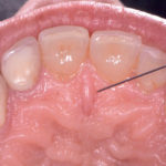 Gestione dinamica e analisi estetica dei trattamenti di denti vitali nel settore anteriore: anestesia selettiva con il sistema Wand