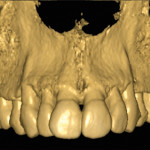 Corticotomie a scopo ortodontico: protocolli clinici e revisione della letteratura