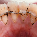 Influenza della contenzione ortodontica sulla salute parodontale