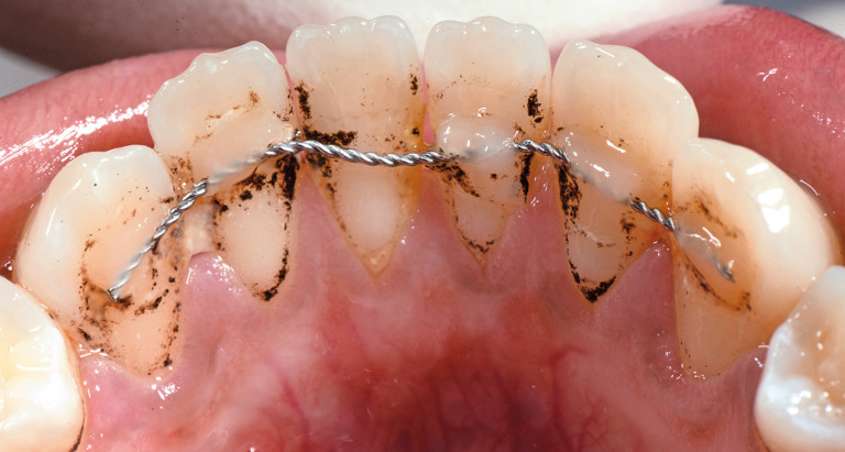 Influenza della contenzione ortodontica sulla salute parodontale