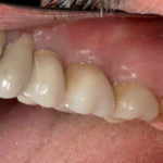 Grande rialzo del seno mascellare eseguito senza materiali da innesto Case report