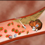 L’intervento odontoiatrico nel paziente con terapia antiaggregante DM_il dentista moderno_aspirina_paziente odontoiatrico in terapia antiaggragante