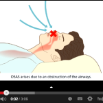 Placche di avanzamento occlusale per il trattamento delle OSAS DM_il dentista moderno_patologie del sonno_odontoiatria_osas_diagnosi_sintomi