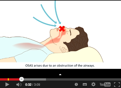 DM_il dentista moderno_patologie del sonno_odontoiatria_osas_diagnosi_sintomi