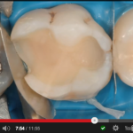 Ruolo e proprietà nei compositi nella restaurativa indiretta DM_il dentista moderno_restaurativa indiretta compositi