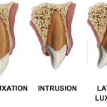 Traumatologia dentale: classificazioni di Andreasen ed Ellis Eziologia dei traumi dentali legamento parodontale classificazione