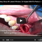 Tecniche chirurgiche per il rialzo di seno mascellare Rialzo di seno mascellare