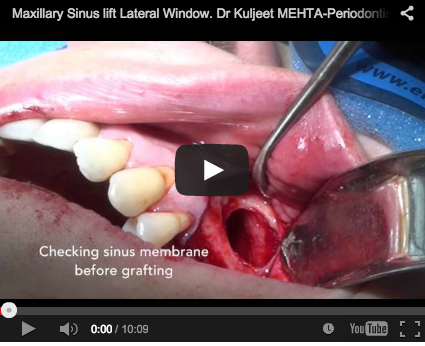 Rialzo di seno mascellare