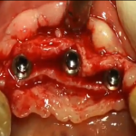 Rialzo di seno mascellare con tecnica di Summers e split-crest rialzo di seno mascellare, tecnica di summers, split crest