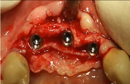 rialzo di seno mascellare, tecnica di summers, split crest