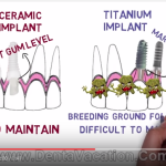 Ossido di zirconio: evidenze scientifiche in vitro, in vivo e sull’ uomo Impianti zirconia ossido di zirconio protesi titanio