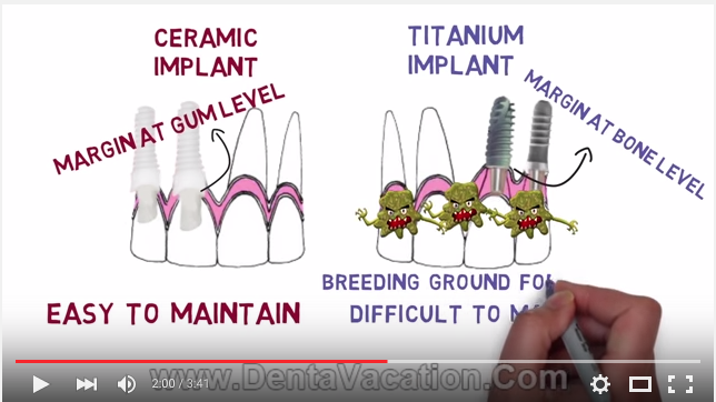 Impianti zirconia ossido di zirconio protesi titanio
