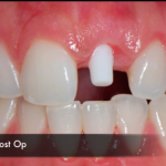 Ossido di zirconio: ecco perché può essere un valido materiale implantare ossido di zirconio protesi corona disilicato di litio