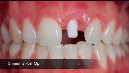 ossido di zirconio protesi corona disilicato di litio