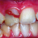 2. Approccio multidisciplinare a un trauma corono-radicolare. Case report