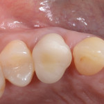 La gestione chirurgico-protesica di tessuti gengivali in un caso estetico – Case report