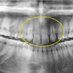 Gestione della distalizzazione canina con le mini-screw in un trattamento ortodontico SW MBT estetico per terapia implantare Z1 connect TBR – Case report