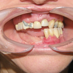 Riabilitazione chirurgica e implanto-protesica in esiti di frattura mandibolare – Caso clinico