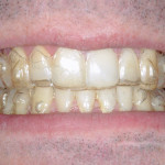 Prevenzione nel paziente ortodontico