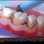 Terapia della parodontite: DEL-1 : inibisce l’osteoclastogenesi trattamento parodontitetrattamento parodontite