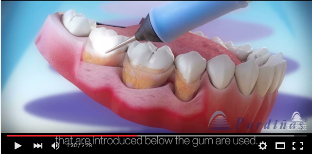 trattamento parodontitetrattamento parodontite