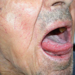 Accorgimenti nel trattamento di pazienti che si sottopongono a radioterapia