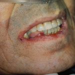 Metastasi gengivale di un adenocarcinoma polmonare: caso clinico