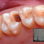 Una nuova tecnica per i restauri in composito: la chairside extraorale