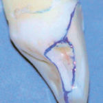 Faccette in ceramica: come evitare fratture e fallimenti?