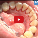 Albero decisionale terapeutico in parodontologia