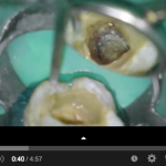 Endodontic challenge: C-shaped canal and anatomical variables DM_il dentista moderno_C-shaped_canale radicolare_endodonzia