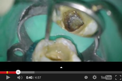 DM_il dentista moderno_C-shaped_canale radicolare_endodonzia