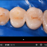 Composizione e caratteristiche dei compositi dentali DM_il dentista moderno_Composizione e caratteristiche dei compositi dentali