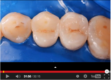 DM_il dentista moderno_Composizione e caratteristiche dei compositi dentali