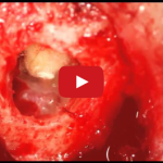 Indicazioni all’apicectomia e alla chirurgia endodontica DM_il dentista moderno_apicectomia_chirurgia endodontica