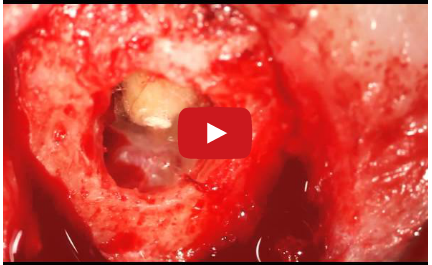 DM_il dentista moderno_apicectomia_chirurgia endodontica