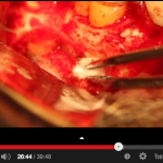 Preparazione cavitaria e otturazione retrograda in chirurgia endodontica DM_il dentista moderno_apicectomia_chirurgia endodontica_otturazione retrograda