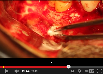 DM_il dentista moderno_apicectomia_chirurgia endodontica_otturazione retrograda