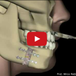 Work-flow digitale e analogico in chirurgia ortognatica