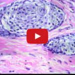 Cisti dei mascellari: eziopatogenesi e processo espansivo DM_il dentista moderno_cisti dei mascellari