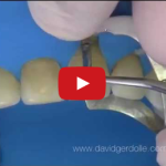 Diga e legature nella cementazione di faccette in ceramica o in composito DM_il dentista moderno_diga di gomma_cementazione faccette in ceramica o in composito