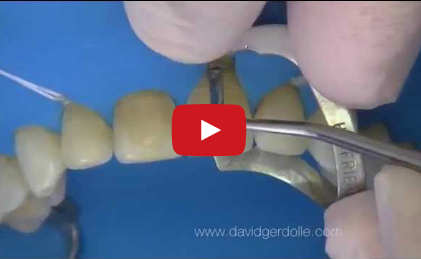 DM_il dentista moderno_diga di gomma_cementazione faccette in ceramica o in composito