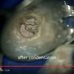 Canali C-shaped in endodonzia DM_il dentista moderno_endodonzia_c-shapeDM_il dentista moderno_endodonzia_c-shape