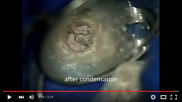 DM_il dentista moderno_endodonzia_c-shapeDM_il dentista moderno_endodonzia_c-shape