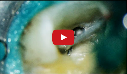 DM_il dentista moderno_endodonzia_strumenti fratturati