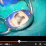 Endodonzia: 9 regole per un facile accesso al sistema canalare DM_il dentista moderno_endodonzia_terapia canalare_sistema canalare