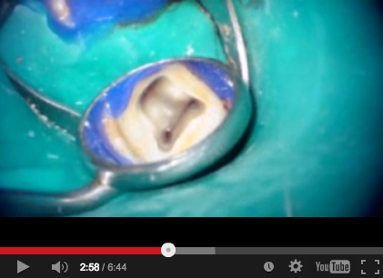 DM_il dentista moderno_endodonzia_terapia canalare_sistema canalare