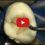 Com’è cambiata l’odontoiatria restaurativa DM_il dentista moderno_odontoiatria restaurativa