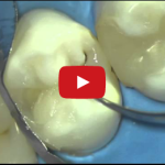 I principi che muovono la moderna odontoiatria restaurativa DM_il dentista moderno_odontoiatria restaurativa